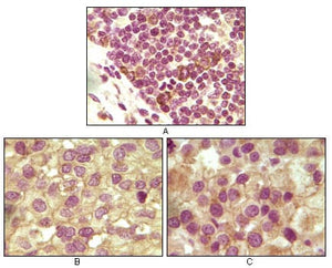 Figure 1: Immunohistochemical analysis of paraffin-embedded human lymphoid (A), ovary tumor (B) and testicle tumor (C) tissues using INHA mouse mAb with DAB staining.