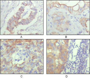 Figure 1: Immunohistochemical analysis of paraffin-embedded human ovary carcinoma (A), kidney carcinoma (B), lung carcinoma (C) and breast carcinoma (D), showing cytoplasmic and membrane localization with DAB staining using ALCAM mouse mAb.