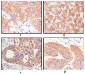 Figure 1: Immunohistochemical analysis of paraffin-embedded human lung squamous cell carcinoma (A),normal hepatocyte (B), colon adenocacinoma, normal stomach tissue (D), showing cytoplasmic and membrane localization using CK mouse mAb with DAB staining.