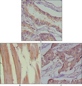 Figure 1: Immunohistochemical analysis of paraffin-embedded human lung cancer (A), muscles (B) and breast cancer (C) using MUSK mouse mAb with DAB staining.