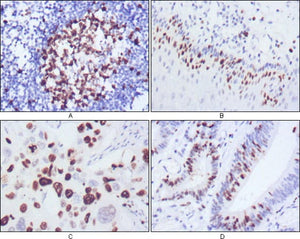 Figure 1: Immunohistochemical analysis of paraffin-embedded human lymph node (A), esophagus (B), lung cancer (C), rectum cancer (D), showing nuclear localization using KI67 mouse mAb with DAB staining.