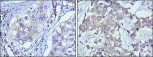 Figure 1: Immunohistochemical analysis of paraffin-embedded human lung cancer (left) and breast cancer (right) using RTN3 mouse mAb with DAB staining.