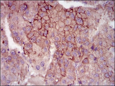 Figure 1: Immunohistochemical analysis of paraffin-embedded liver cancer tissues using MELK mouse mAb with DAB staining.