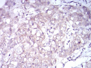 Figure 1:Immunohistochemical analysis of paraffin-embedded breast cancer tissues using NTRK2 mouse mAb with DAB staining.