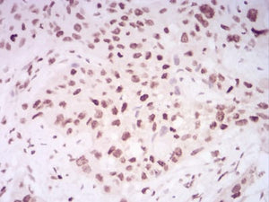 Figure 1:Immunohistochemical analysis of paraffin-embedded esophageal cancer tissues using HIST2H4A(20Me) mouse mAb with DAB staining.