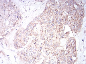 Figure 1:Immunohistochemical analysis of paraffin-embedded ovarian cancer tissues using SK2 mouse mAb with DAB staining.