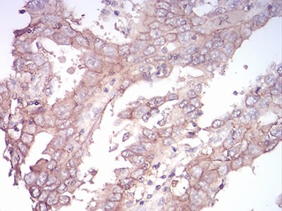 Figure 1:Immunohistochemical analysis of paraffin-embedded endometrial cancer tissues using SK2 mouse mAb with DAB staining.