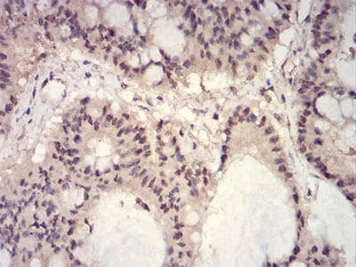 Figure 1:Immunohistochemical analysis of paraffin-embedded colon cancer tissues using HIST2H3C(27Ac) mouse mAb with DAB staining.