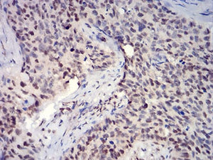 Figure 1:Immunohistochemical analysis of paraffin-embedded cervical cancer tissues using HIST2H3C(27Ac) mouse mAb with DAB staining.