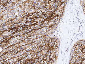 GeneAbTM CD138 [IHC138] on Liver Cancer