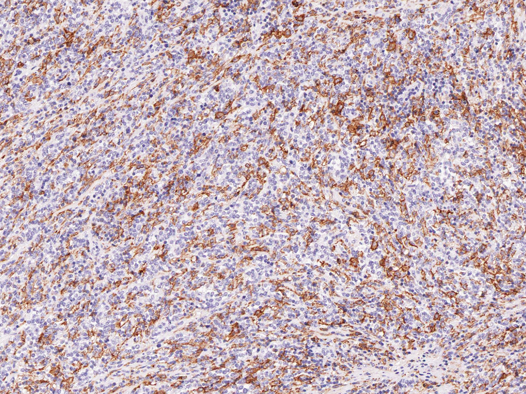 Anti-Hairy Cell Leukemia Monoclonal Antibody
