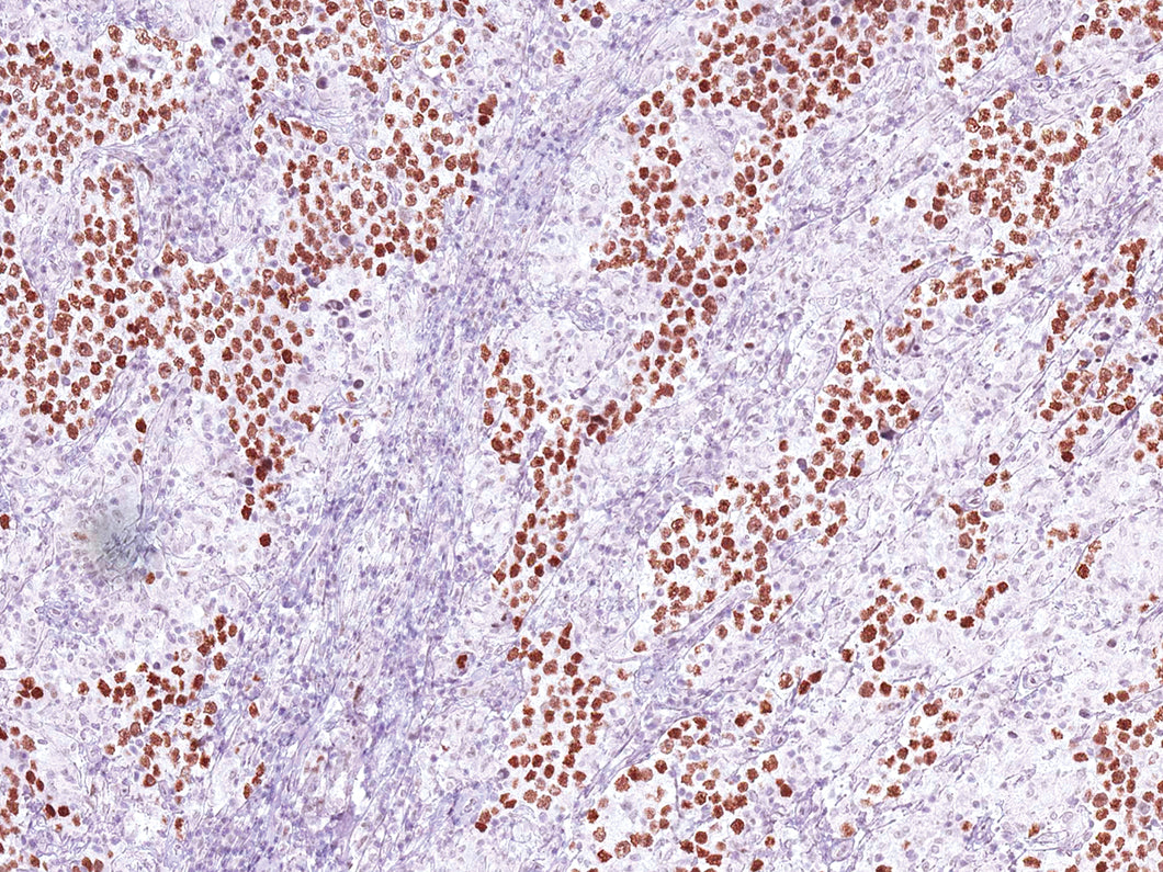 GeneAbTM Nanog [IHC634] on Testicular Cancer