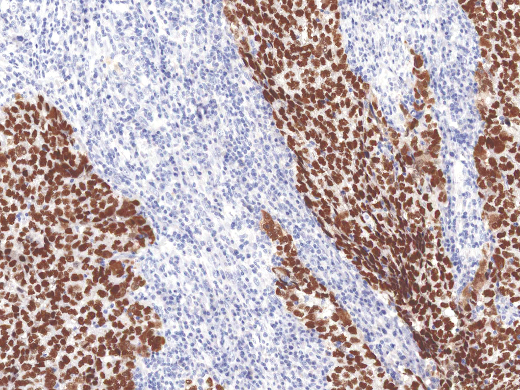 GeneAbTM SALL4 [IHC659] on Testicular Cancer