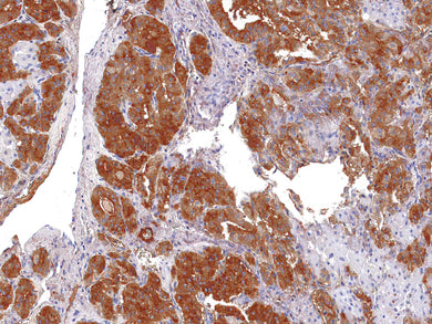 GeneAbTM Thyroglobulin [IHC674] on Thyroid Cancer