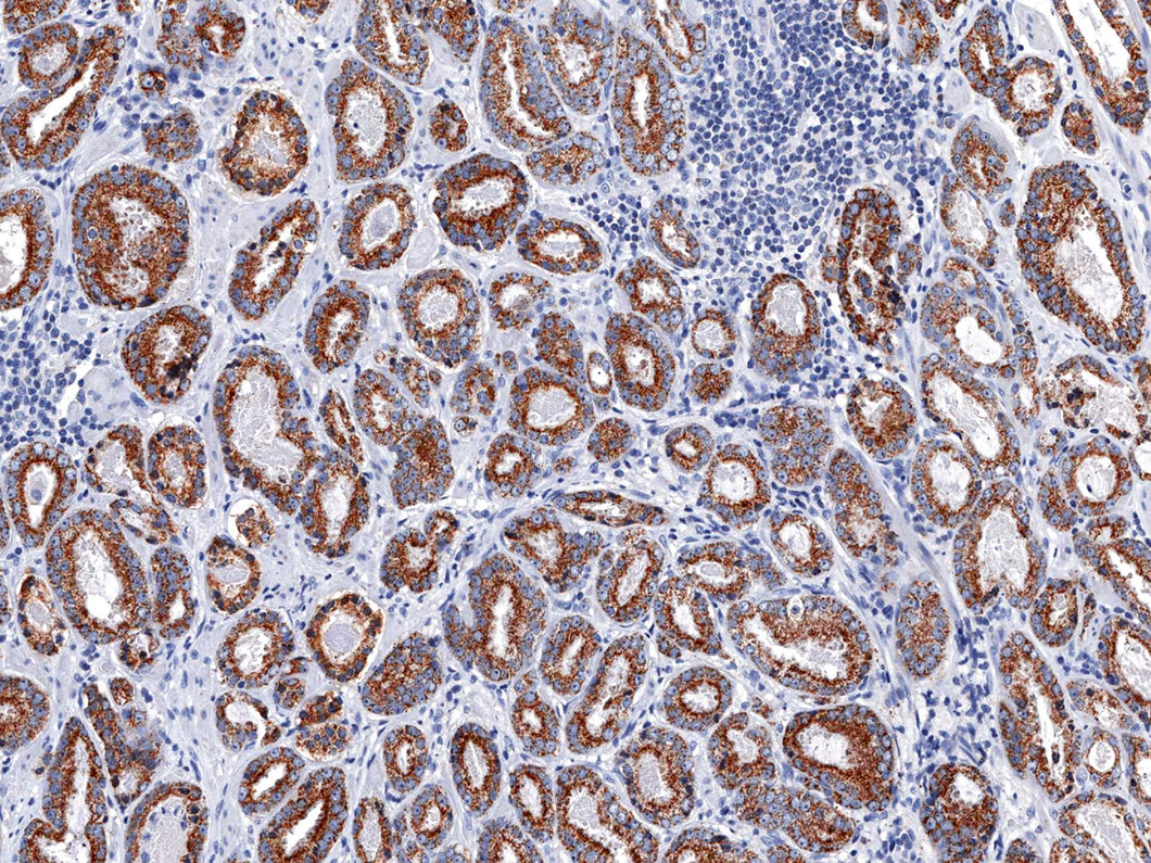 GeneAbTM p504s [IHC504] on Prostate Cancer